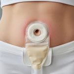 Close-up of intact, healthy peristomal skin around a stoma with an ostomy pouch properly fitted on the abdomen.