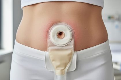 Close-up of intact, healthy peristomal skin around a stoma with an ostomy pouch properly fitted on the abdomen.